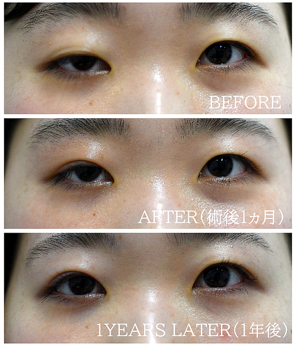 重度の眼瞼下垂手術の症例写真（挙筋腱膜法）