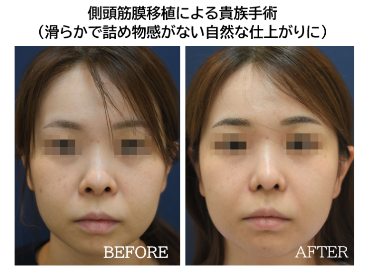 貴族手術の症例写真