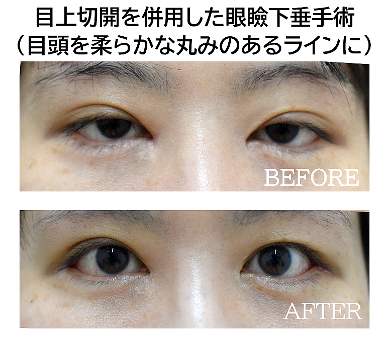 眼瞼下垂＋目上切開法の症例写真