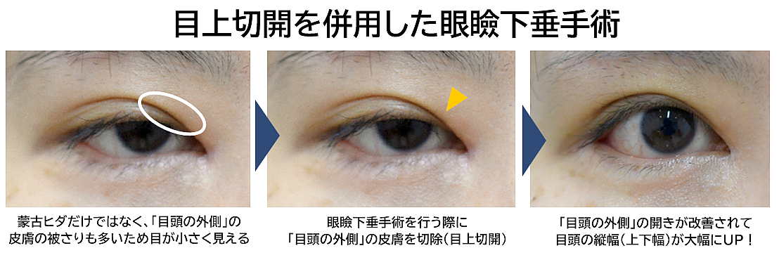 眼瞼下垂＋目上切開法の症例写真