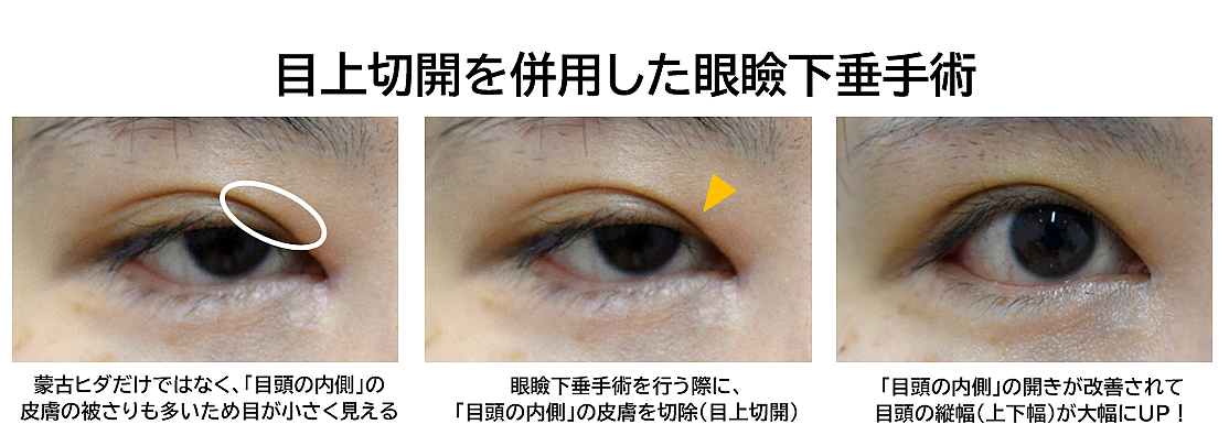 眼瞼下垂＋目上切開法の症例写真