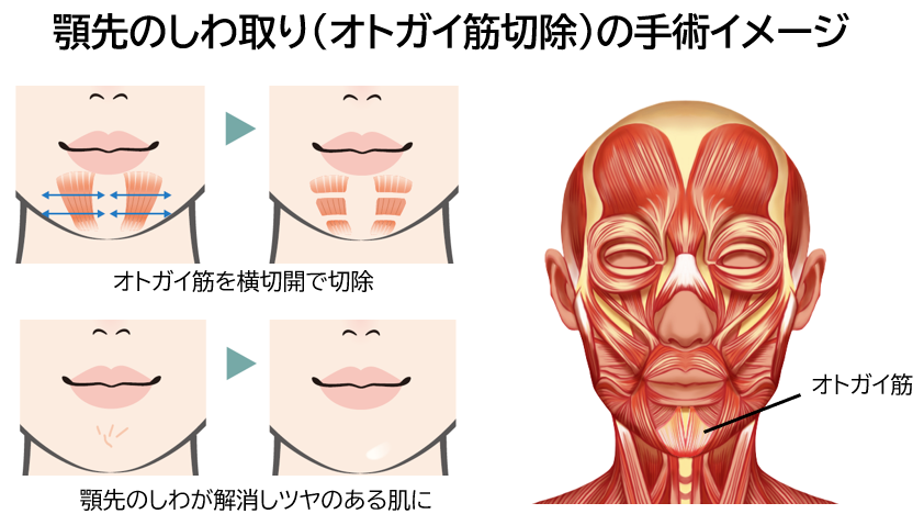 オトガイ筋切除