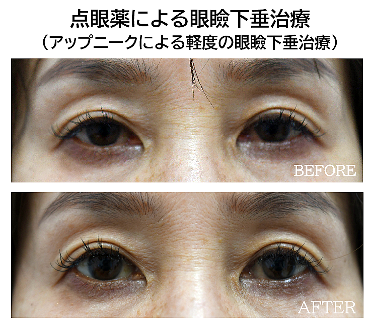 アップニークによる眼瞼下垂治療の症例写真