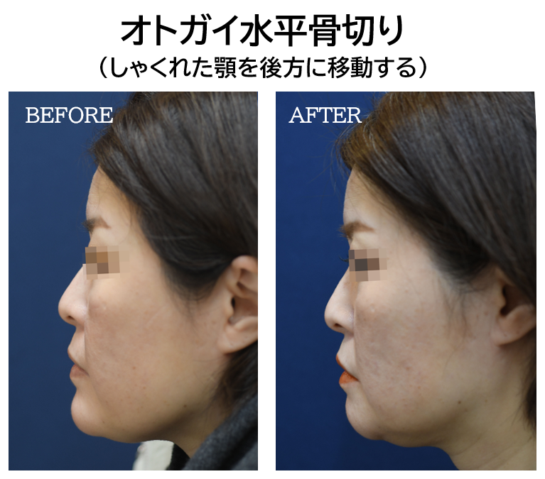おとがい形成の症例写真(しゃくれた顎)