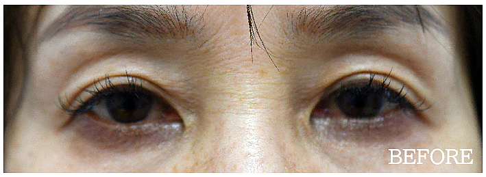 点眼薬による眼瞼下垂治療の症例写真