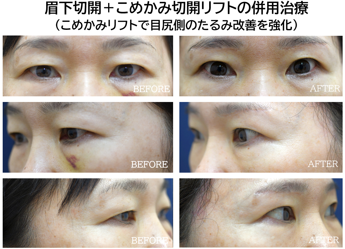 上まぶたのたるみ取りの症例写真
