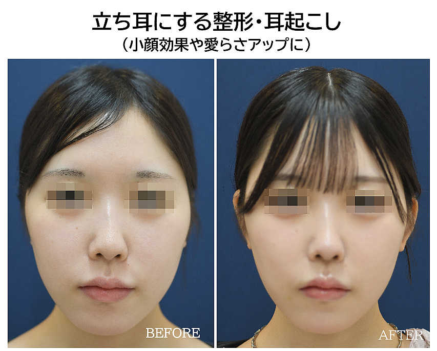 立ち耳にする整形の症例写真