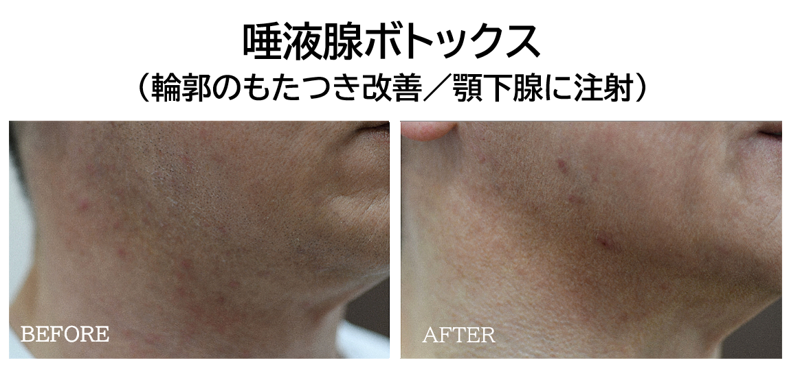 唾液腺ボトックスの症例写真