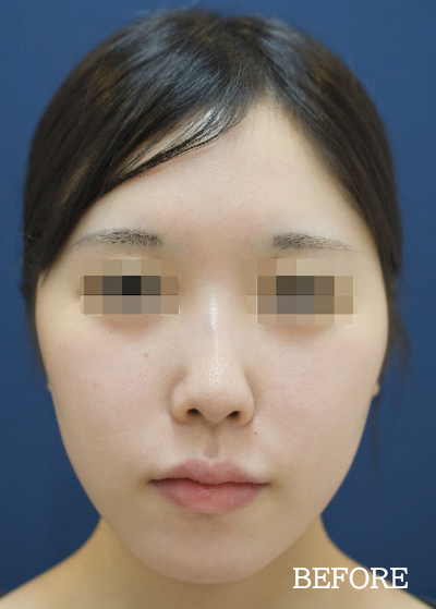 立ち耳にする整形の症例写真