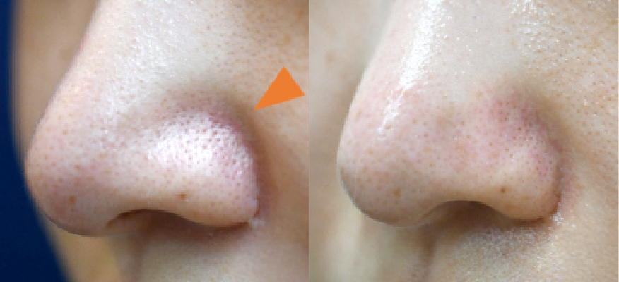 鼻翼溝を薄くする（他院での鼻尖形成後の修正手術）