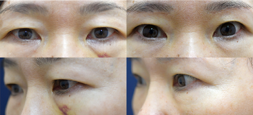 40代以降に有効なまぶたのたるみ取り（こめかみリフトの併用）
