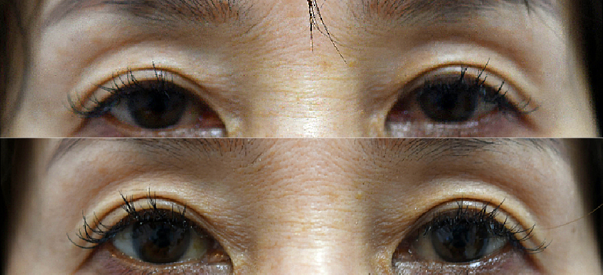 【切らない眼瞼下垂治療】アップニーク点眼薬が発売になりました