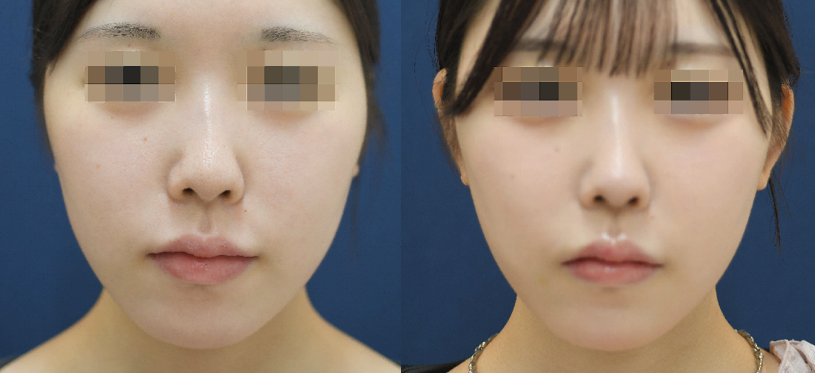 後戻りしにくい軟骨移植による耳起こし・立ち耳手術【肋軟骨も可】