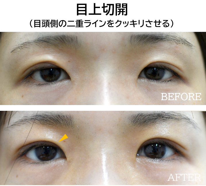 目上切開の症例写真