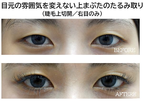 睫毛上切開(上まぶたのたるみ取り)の症例写真
