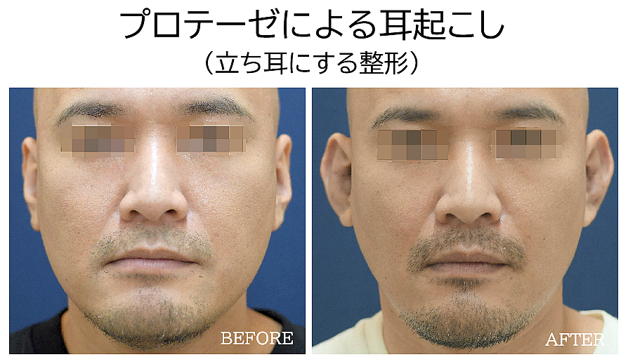 耳プロテーゼ（立ち耳にする整形）の症例写真