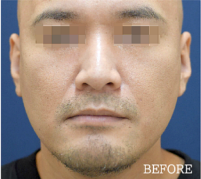 耳プロテーゼ（立ち耳にする整形）の症例写真