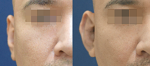 耳プロテーゼ（立ち耳にする整形）の症例写真