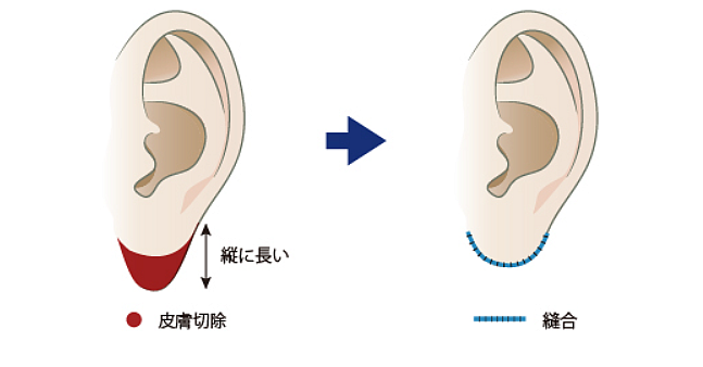 耳たぶを小さくする整形