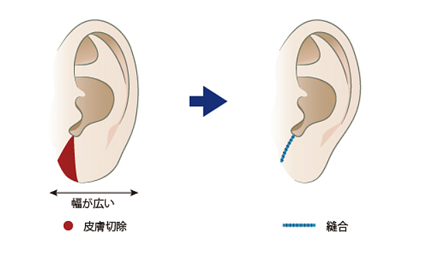 耳たぶを小さくする整形