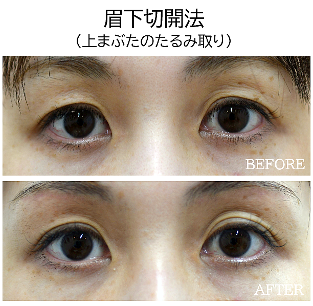 眉下切開による上まぶたのたるみ取りの症例写真