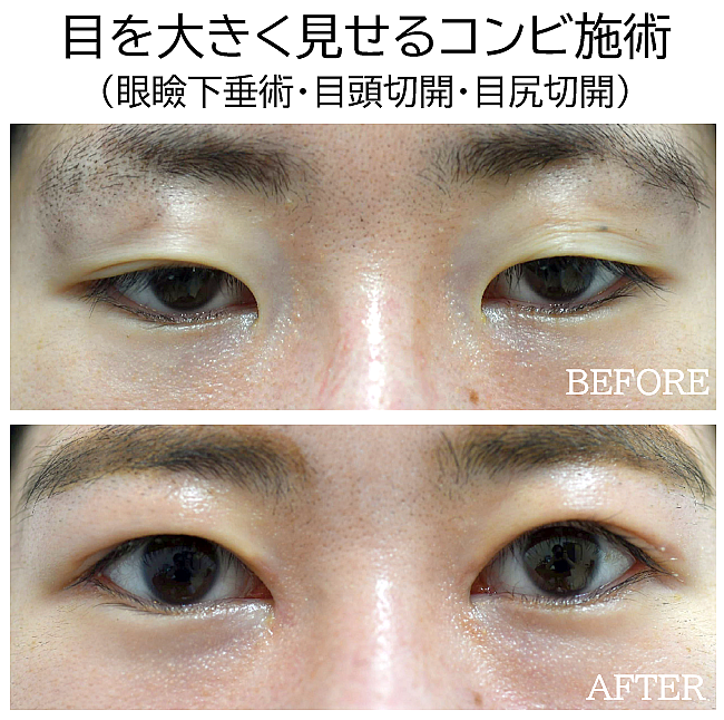 目元整形（コンビ治療）の症例写真